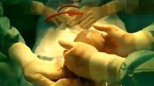 Кесарево сечение. Извлечение плода в целом околоплодном пузыре.