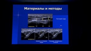 Малецкий Э.Ю. - Оптимизация методики УЗИ площади поперечного сечения локтевого нерва