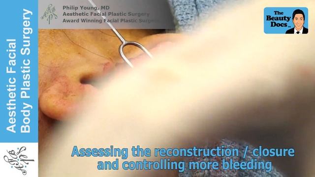 KELOID EAR HELIX REMOVAL LIVE SURGERY by Dr Philip Young of Seattle Bellevue & AFPS Plastic Surgery смотреть онлайн