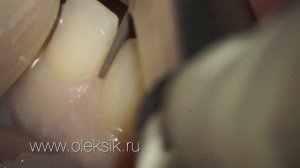 Виниры. Верхний фронт под рефрактор и ДДТ