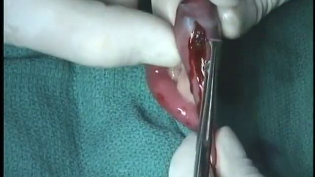 Энтеротомия