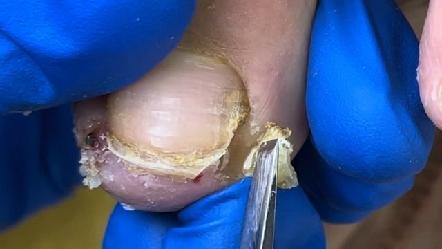 Carefully Separate Ingrown Nails To Treat Paronychia【Xue Yidao】