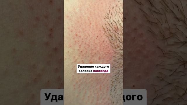 Электроэпиляция, в отличие от лазера и других видов эпиляции, удаляет волосы навсегда? смотреть онлайн