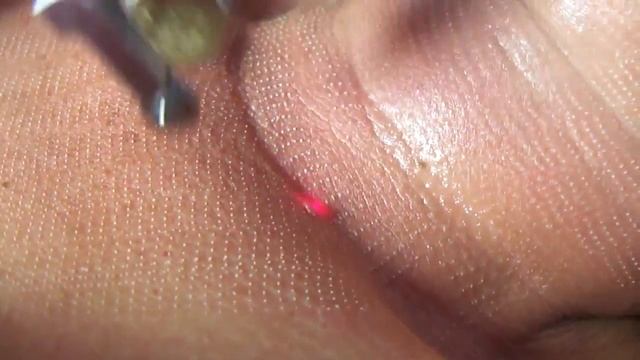 Фракционное омоложение декольте при помощи СО2 смотреть онлайн