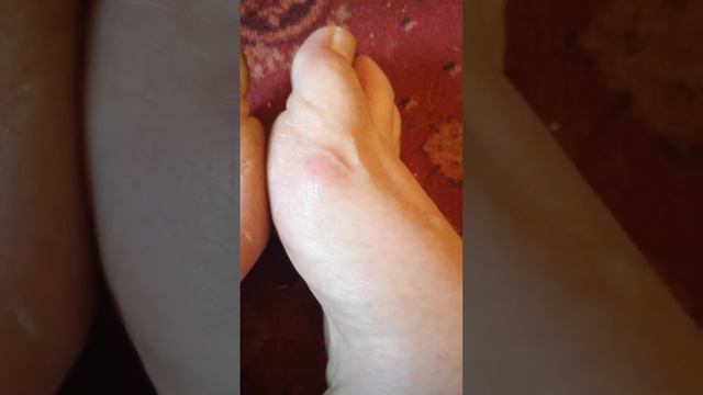 GOUT IN BOTH FEET смотреть онлайн