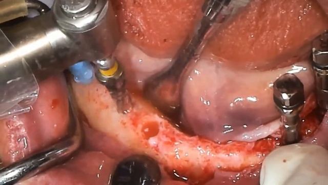 Short OSStem Implants, Densah Osseodensification Kit, Osstem İmplant