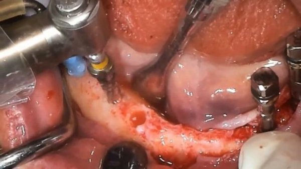 Short OSStem implants, Densah Osseodensification Kit, Osstem İmplant