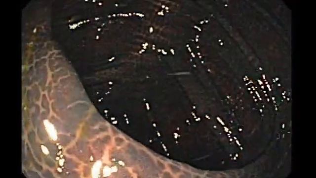 Black Colon Melanosis Coli смотреть онлайн