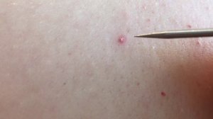 Гнойные прыщи на голове. Загноившийся корень волоса.