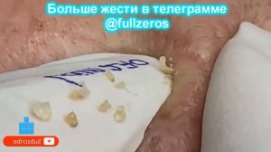 Новое! Выдавливание прыщей # Удаление черных точек 2021 # Прыщи выдавливание # Черная маска