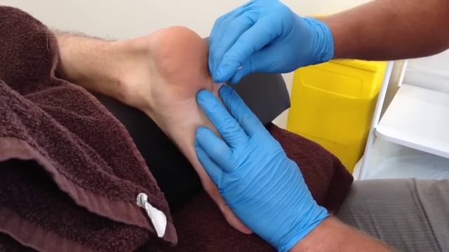 Dry Needling: Quadratus Plantae смотреть онлайн