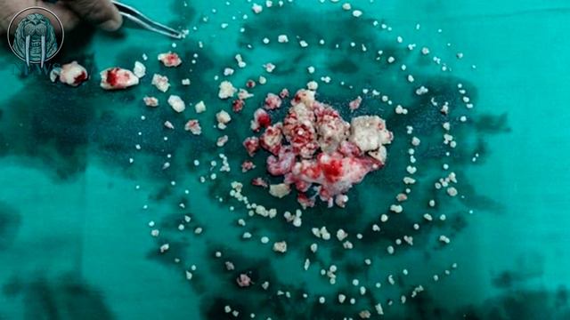 232 ЗУБА УДАЛИЛИ У ПОДРОСТКА ИЗ ИНДИИ смотреть онлайн