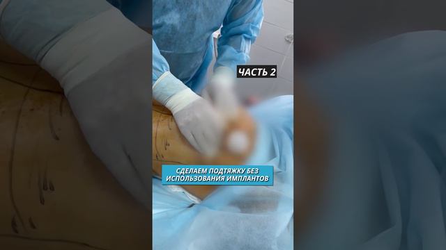 Убрали большой живот и сделали красивую грудь за одну операцию! Часть 1