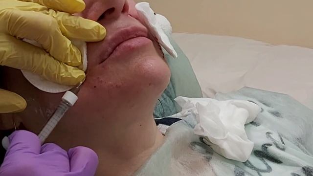 Заполнение морщин филлером. Периоральная область, нижняя часть лица. смотреть онлайн