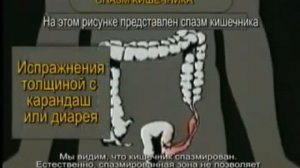 СМЕРТЬ ПРИТАИЛАСЬ В ТОЛСТОЙ КИШКЕ?