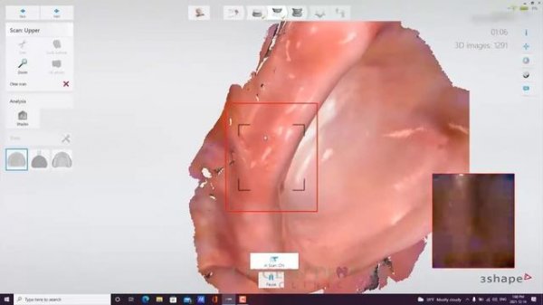 Trios 4 Upper and Lower Scans with Centric Tray