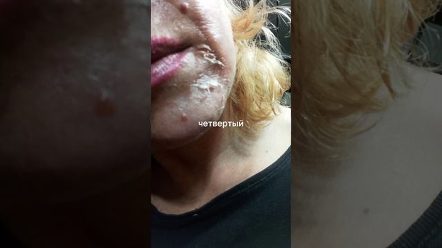 Пилинг Джесснера смотреть онлайн