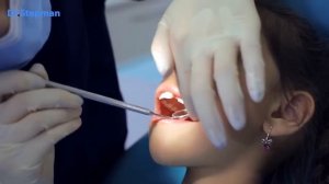 Лечение кариеса молочных зубов у детей