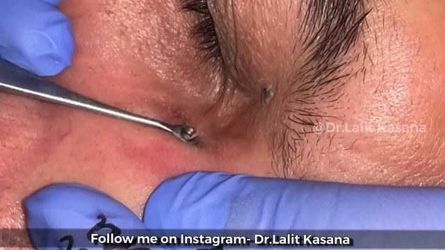 35 YEARS OLD DEEP BLACKHEAD REMOVAL BY DR.LALIT KASANA / NEW BLACKHEAD VIDEO смотреть онлайн