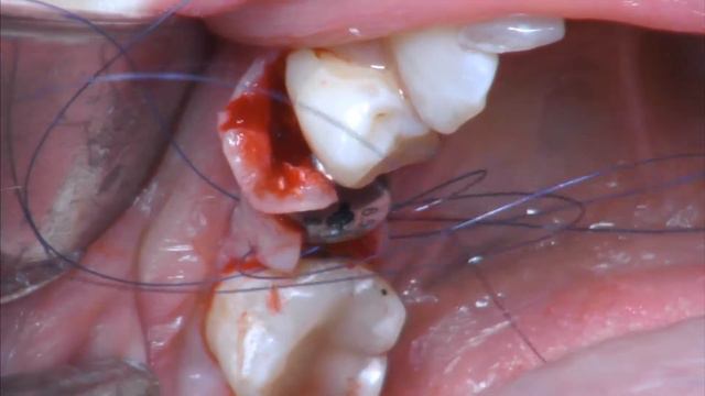 Установка дентального имплантанта (врач-стоматолог хирург Гиноян Т.М.) смотреть онлайн