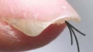 СМОТРИ, КАК ЕГО УБРАТЬ, ЧТО ТАКОЕ ГИПОНИХИЙ? ОТКУДА ПОЯВЛЯЕТСЯ ГИПОНИХИЙ? НАРОСШАЯ КОЖА ПОД НОГТЕМ.