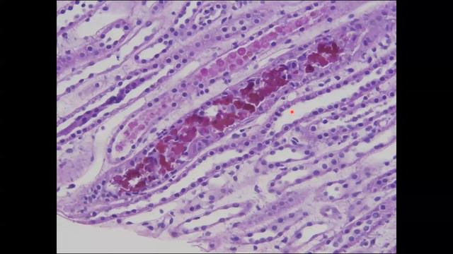 Nephropathology Session 11 смотреть онлайн