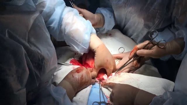 Надвлагалищная ампутация матки смотреть онлайн