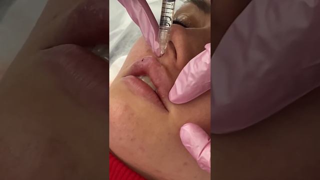 Процесс увеличения губ у косметолога. Как проходит процедура увеличения губ смотреть онлайн