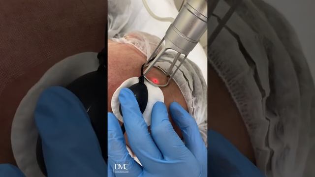 Лечение рубцов постакне. Лазерная шлифовка CO2 смотреть онлайн