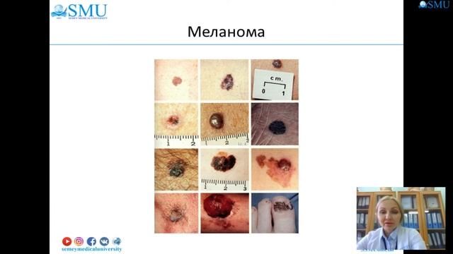 Рак кожи, в т ч меланома кожи