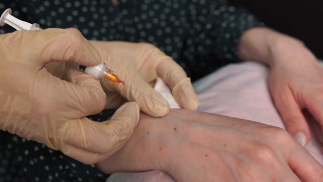 ОММЕ. Коррекция тыльной поверхности кистей смотреть онлайн