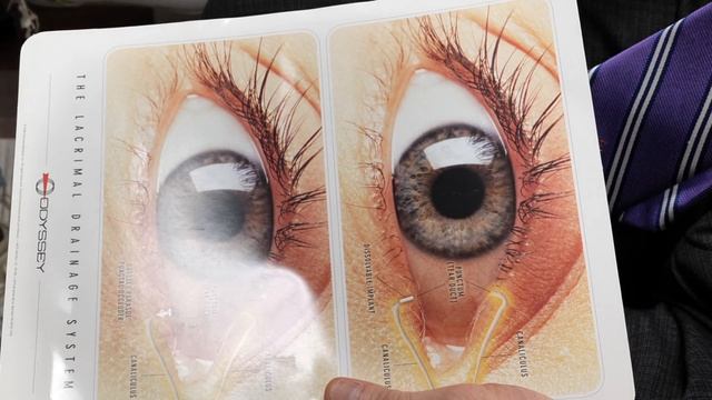 What is the bump on my eyelid? Treatment of a Chalazion. смотреть онлайн