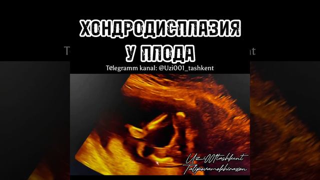 ХОНДРОДИСПЛАЗИЯ У ПЛОДА смотреть онлайн