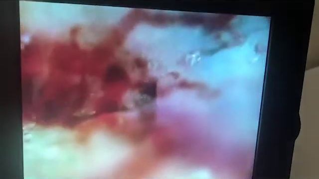 Капилляроскопия+ФДТ смотреть онлайн