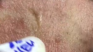 Relax squeezing out blackheads #33 Черные точки
