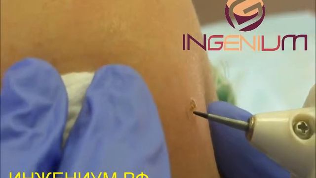 Удаление новообразований смотреть онлайн
