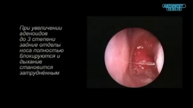 эндоскопия носоглоткистепени аденоидов) смотреть онлайн