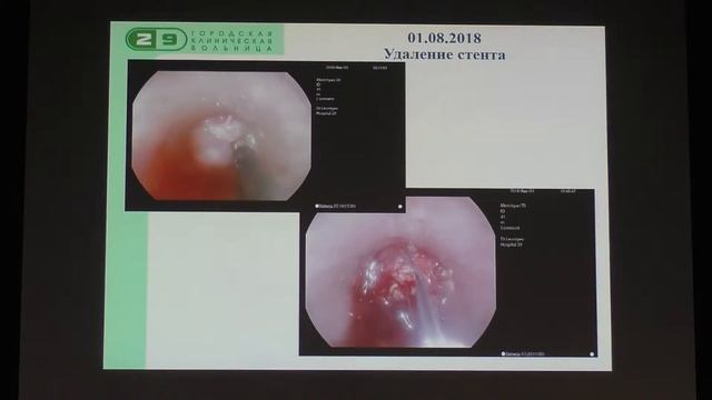 08 Леонтьев АС Успешное эндоскопическое лечение осложненной продольной резекции желудка SADI по пов смотреть онлайн
