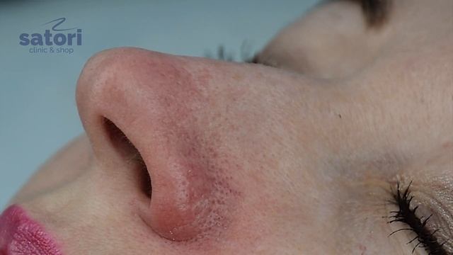 Удаление сосудистой сетки на лице | косметология Самара смотреть онлайн