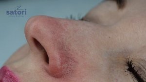 Удаление сосудистой сетки на лице | косметология Самара