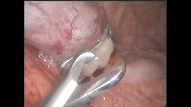 Лапароскопическая аппендэктомия (DS-клипсы) смотреть онлайн