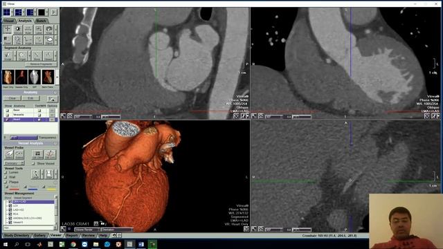 Anomalous LCX from right coronary sinus with retroaortic course смотреть онлайн