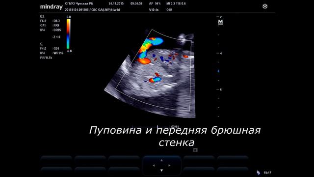 Проведение первого скрининга при риске ХА смотреть онлайн