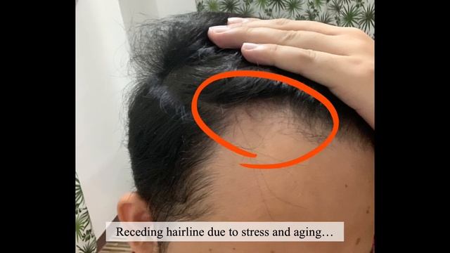Minoxidil Strands Review- RESULT after using for 5 months | Effective or Not? смотреть онлайн
