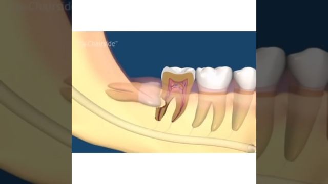 Зубы мудрости, хорошо или плохо?мнение экспертов