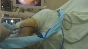 артроскопия коленного сустава