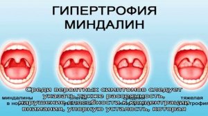 Симптомы и лечение увеличенных гланд у взрослых