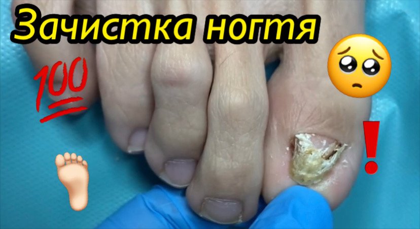 Зачистка ногтя????❗️ смотреть онлайн