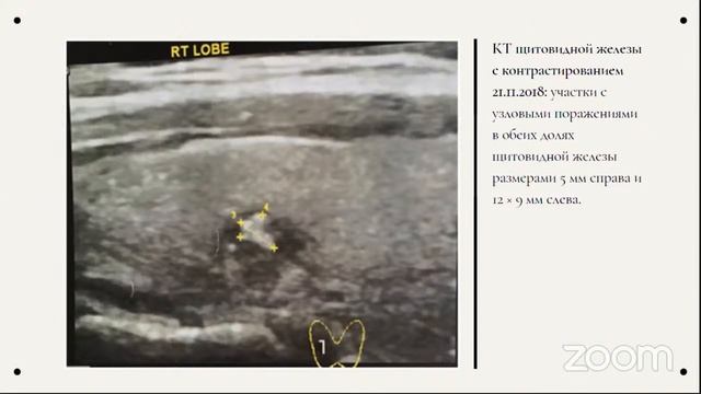 Множественная эндокринная неоплазия смотреть онлайн