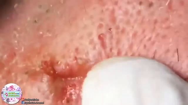 УГРИ   ПРЫЩИ НА ЛИЦЕ! ДАВЛЮ Как избавиться от черноголовых ! How to get rid of blackheads6